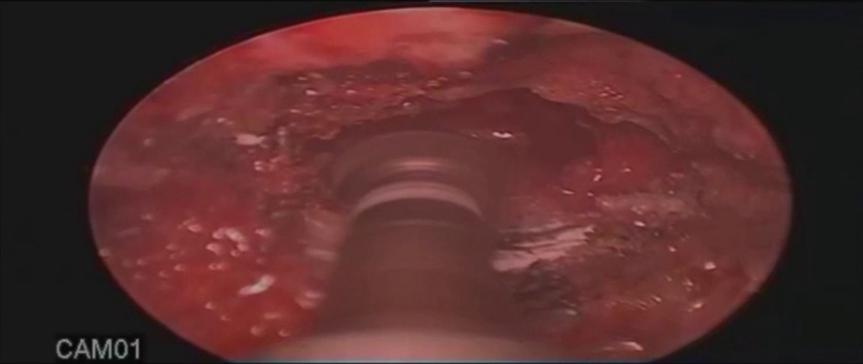 Endoscopic Lumbar Discectomy