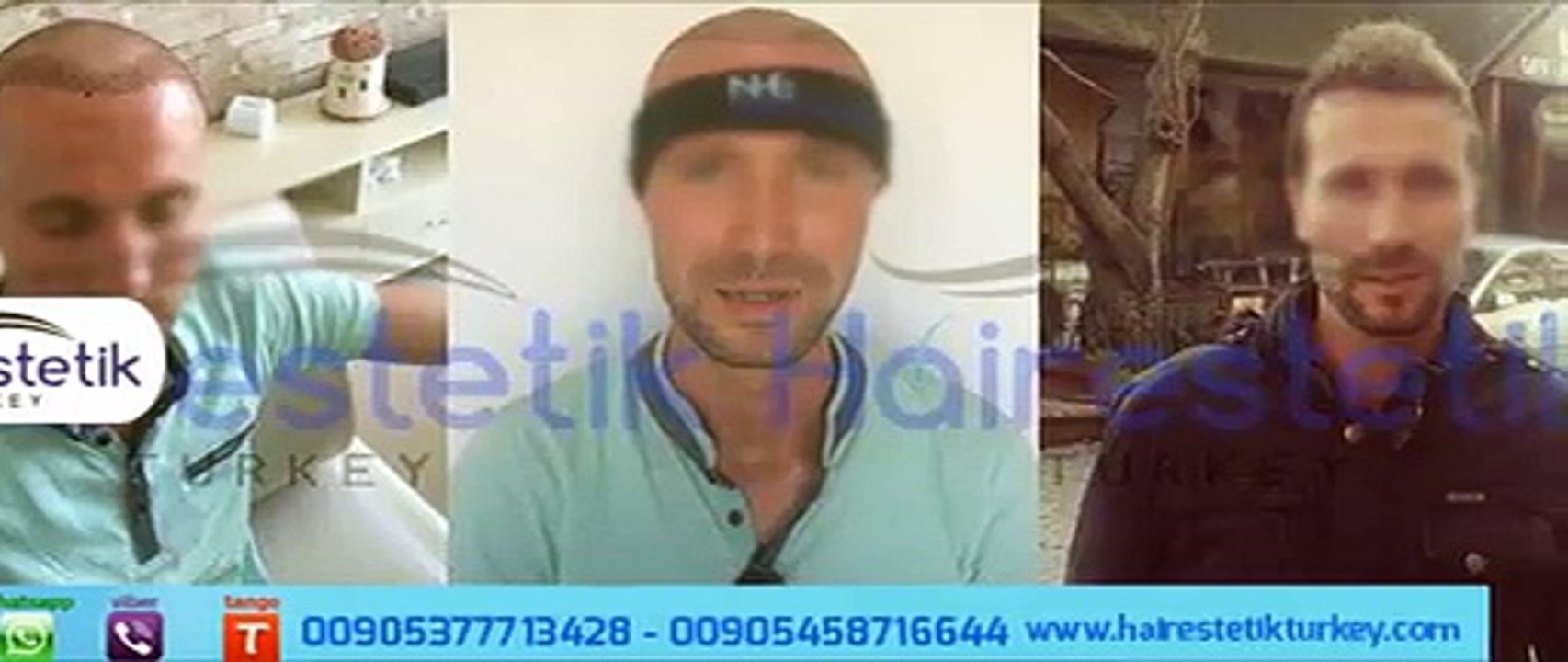 http://www.hairtransplantcenter.org hair transplant turkey, hair transplant in turkey, hair implant turkey, hair transplant cost, hair transplant istanbul,