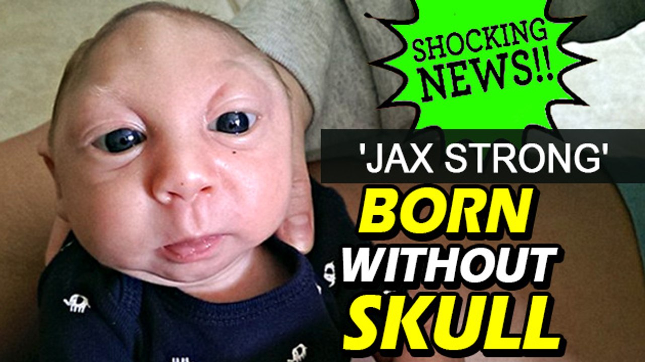 Shocking News 'Jax Strong' Born Without Skull