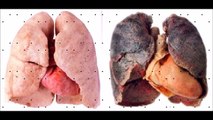 Akciğer Kanserinde Erken Tanı - Sntlife.Com