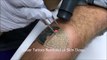 Laser Tattoo Removal at Skin Deep in Northern VA