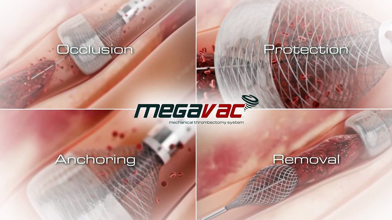 Capture MegaVac Mechanical Thrombectomy System