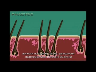 Імплантація волосся методом S.H.E. - клініці PHAEYDE (1/3)