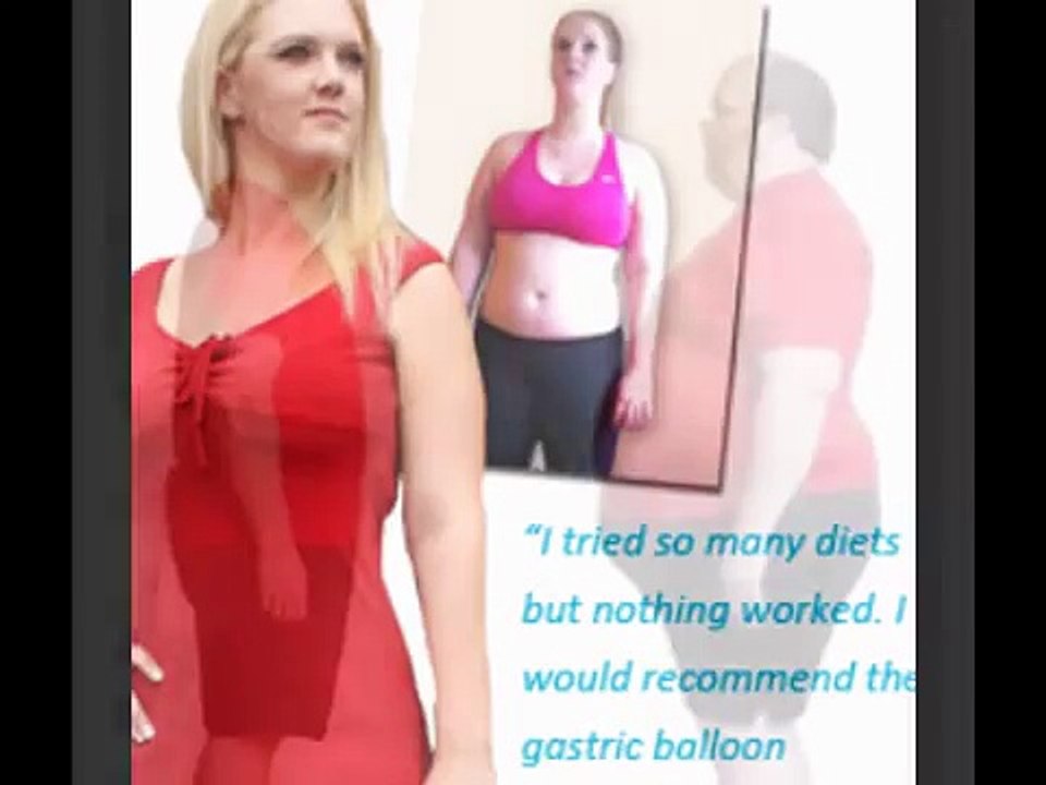 bariatric stomach balloon weight loss