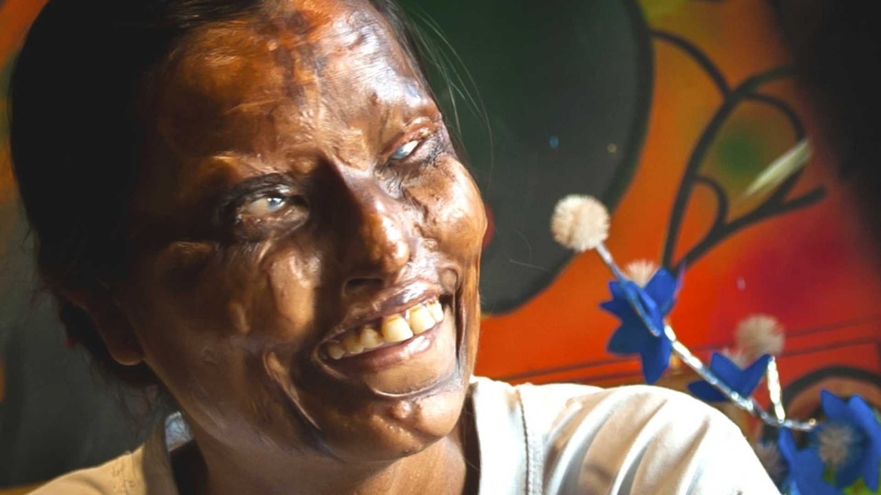 Acid Attack Café Restores Victims' Lives