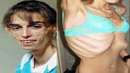 EL PEOR CASO DE ANOREXIA. Una lección para la humanidad. Kate Chilver