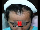 Hair transplant forum, hair transplant in turkey, hair transplant blog