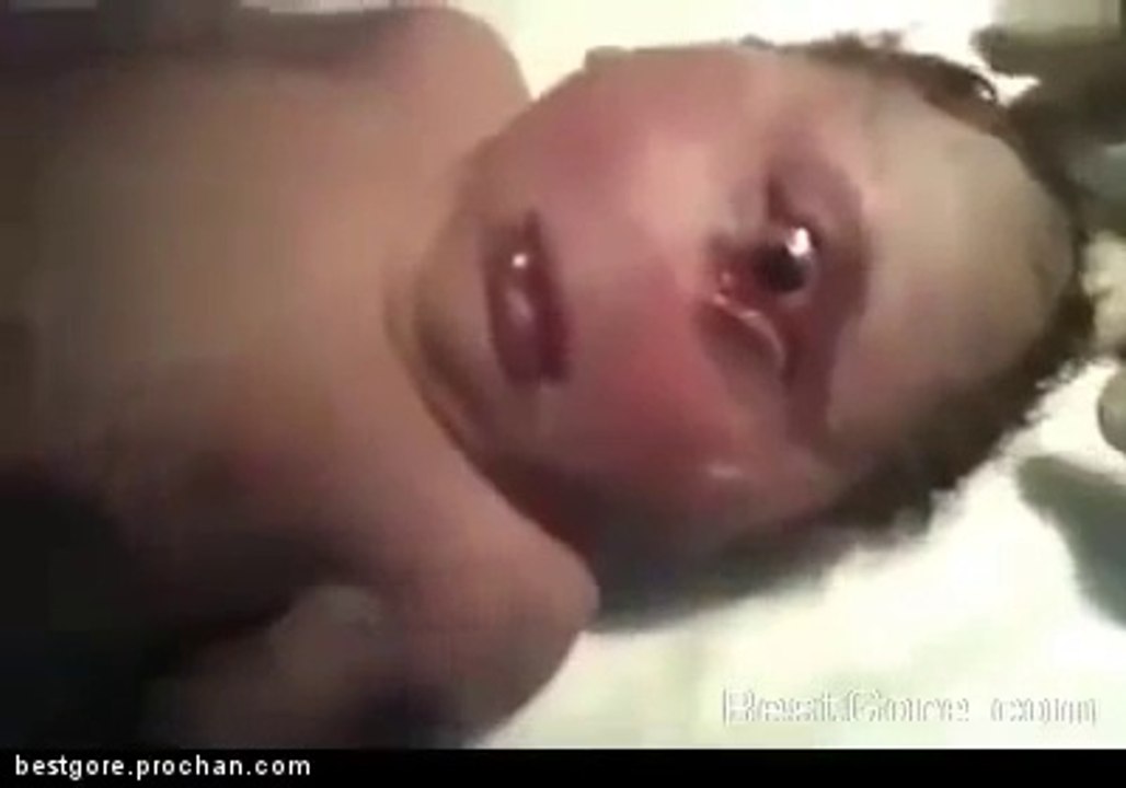 BABY BORN WHITH DEFECT