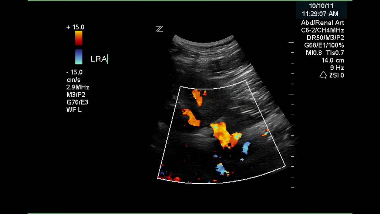 Normal Renal Arterial Doppler - Case Study