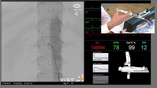 Popular Videos - Renal artery & Stenosis