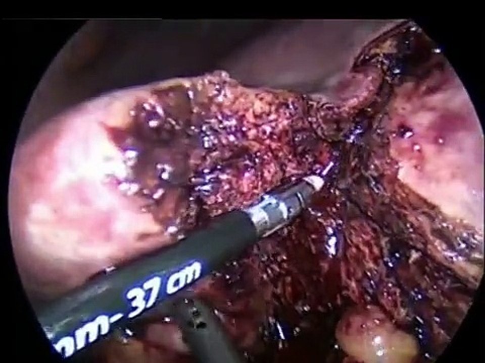 Gallbladder cancer & Laparoscopic surgery