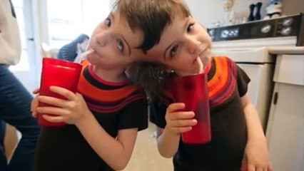 Sono gemelli che convivono in un solo corpo, ma sono speciali!
