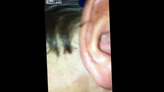 Si tuffa nel lago ed esce con un ronzio in testa: ecco cosa ha trovato nel suo orecchio!