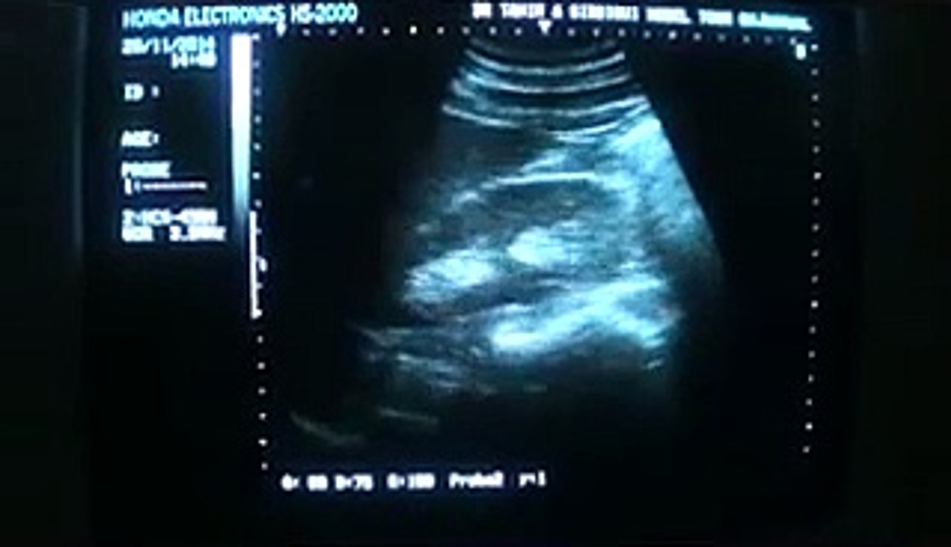 ⁣Popular Videos - Renal artery & Vein