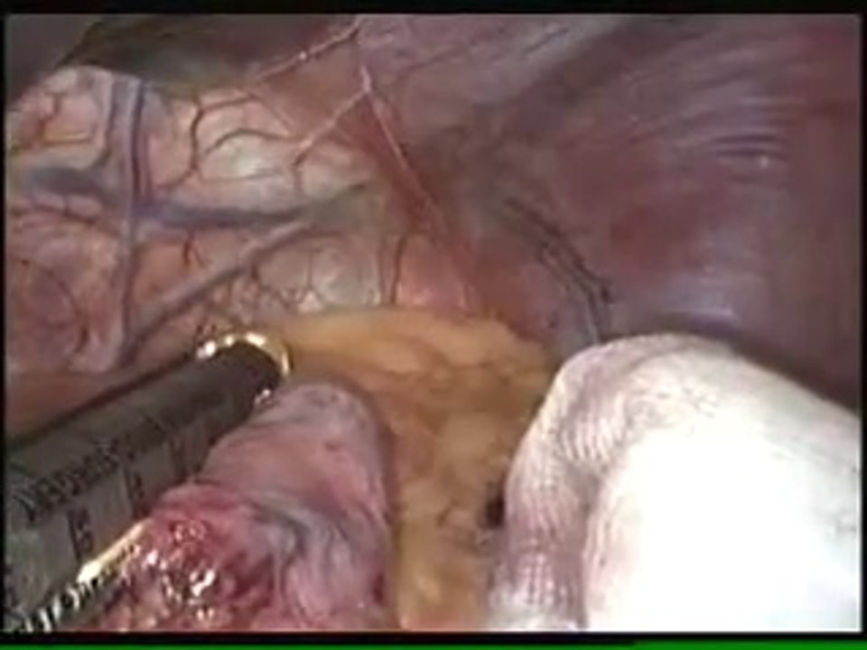 Roux-en-Y Gastric Surgery Bypass In Delhi