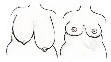 What Breast Reduction Actually Feels Like