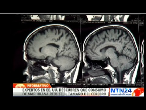 Estudio revela que el tamaño del cerebro de los consumidores de marihuana tiende a reducirse