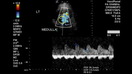 Duplex Demonstration of Normal Renal Arterial Blood Flow - Case Study