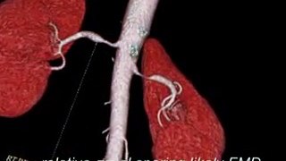 Renal Artery Stenosis