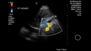 Duplex Demonstration of Normal Renal Arterial Blood Flow - Case Study