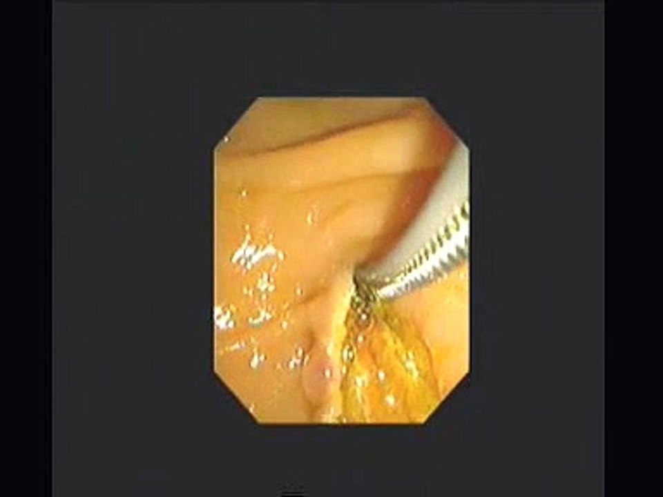 ERCP - Sphincterotomy, biopsies & SEMS for Pancreatic cancer - STEFANOS DOKAS - The ERCP C