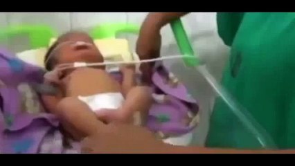 Ce bébé est né avec 2 trompes à la place du nez !