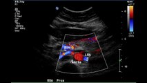 Popular Videos - Renal artery & Duplex ultrasonography