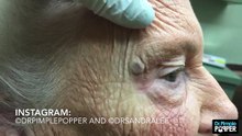Une vieille dame se fait extraire un gros comédon au niveau de l’œil
