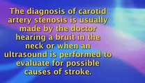 Popular Videos - Carotid artery stenosis & Carotid stenting