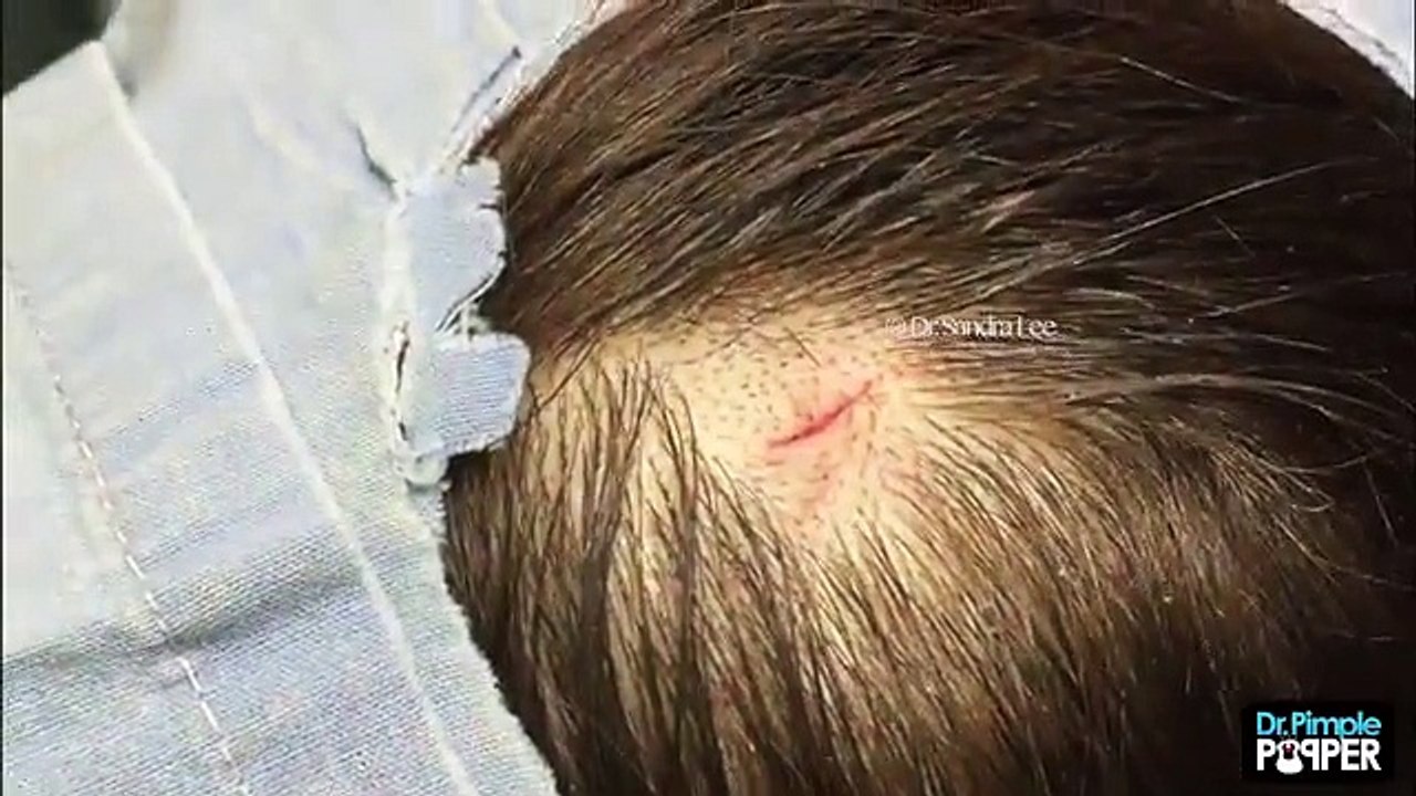 Medical Videos Head Cyst Pimple Removal Procedure