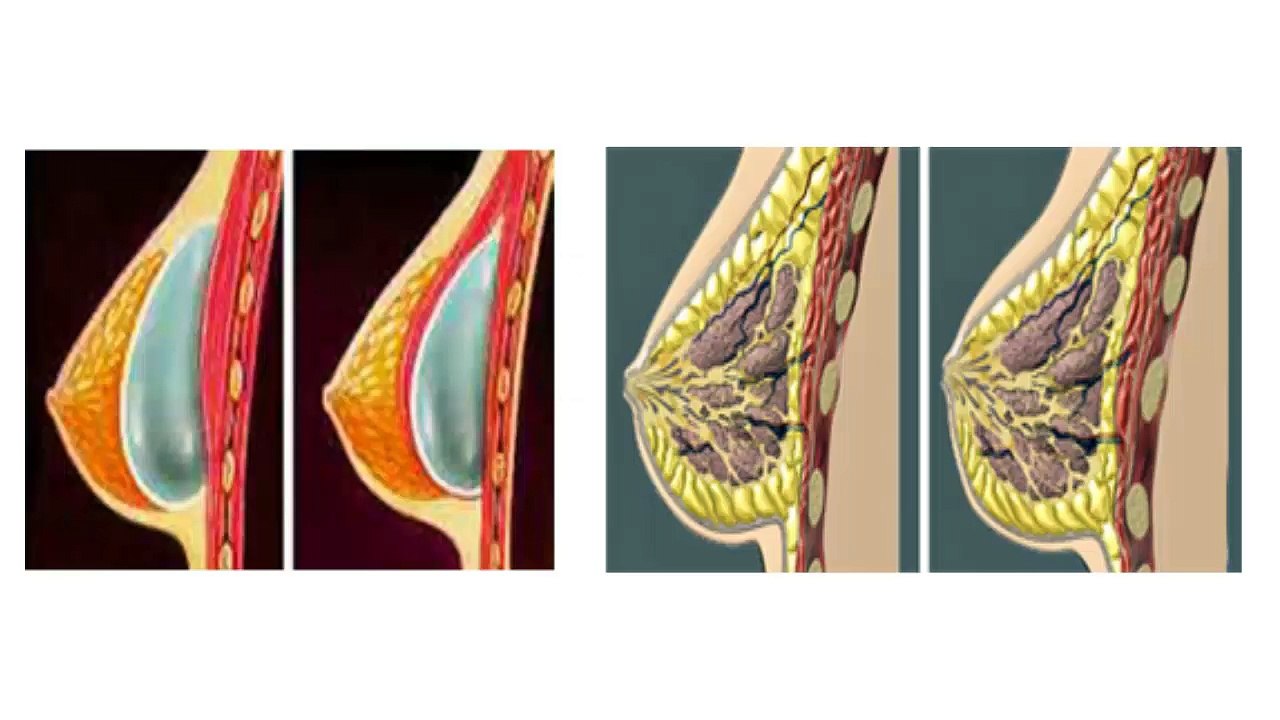Augmentation Mammaire Naturelle