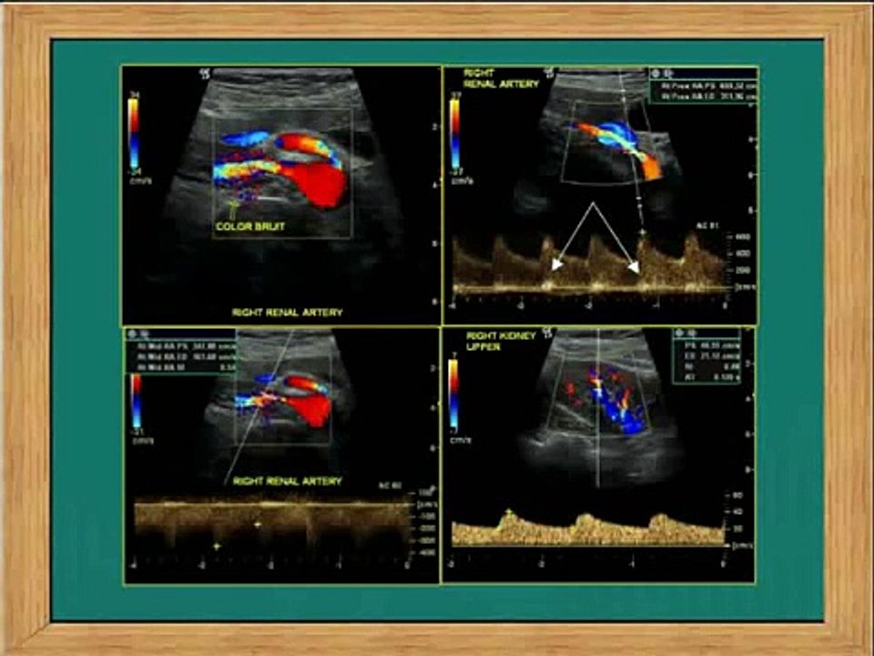 Renal Arterial Stenting - Secondary Hypertension - Live Case Part 1 - RHC Berlin 2014