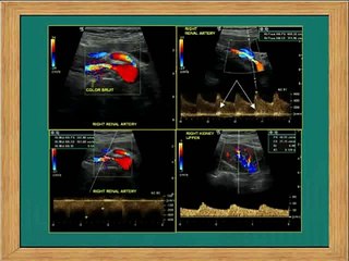 Renal Arterial Stenting - Secondary Hypertension - Live Case Part 1 - RHC Berlin 2014