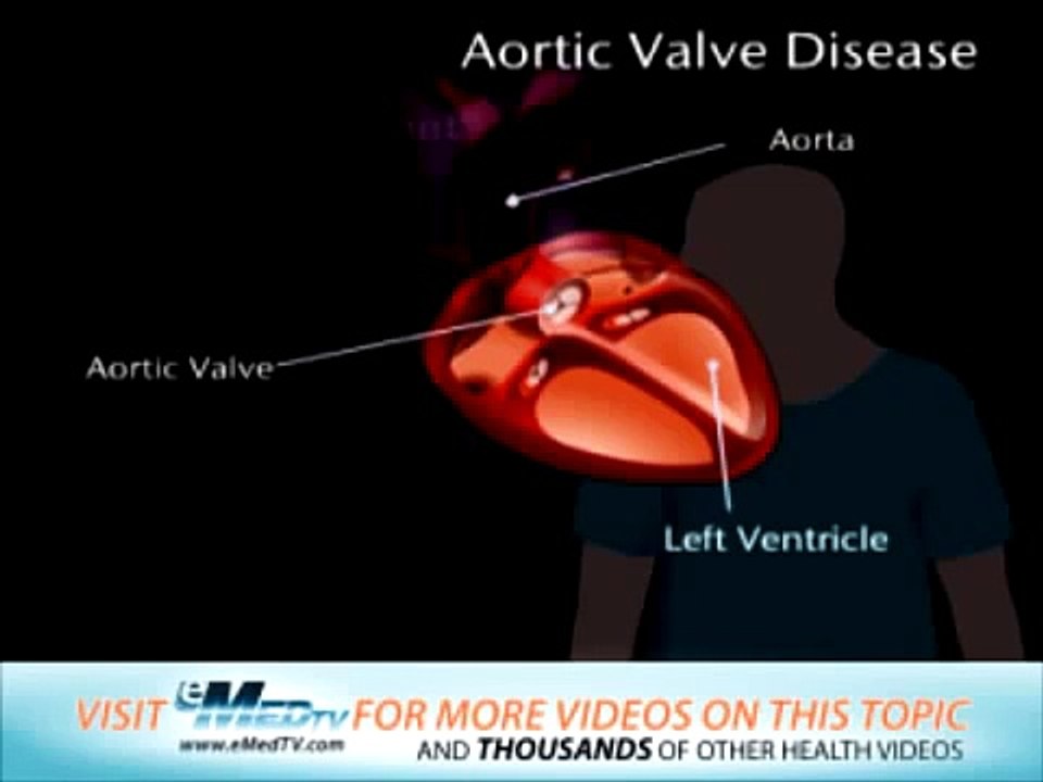 Aortic Valve Disease