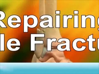 Ankle Fracture Repair