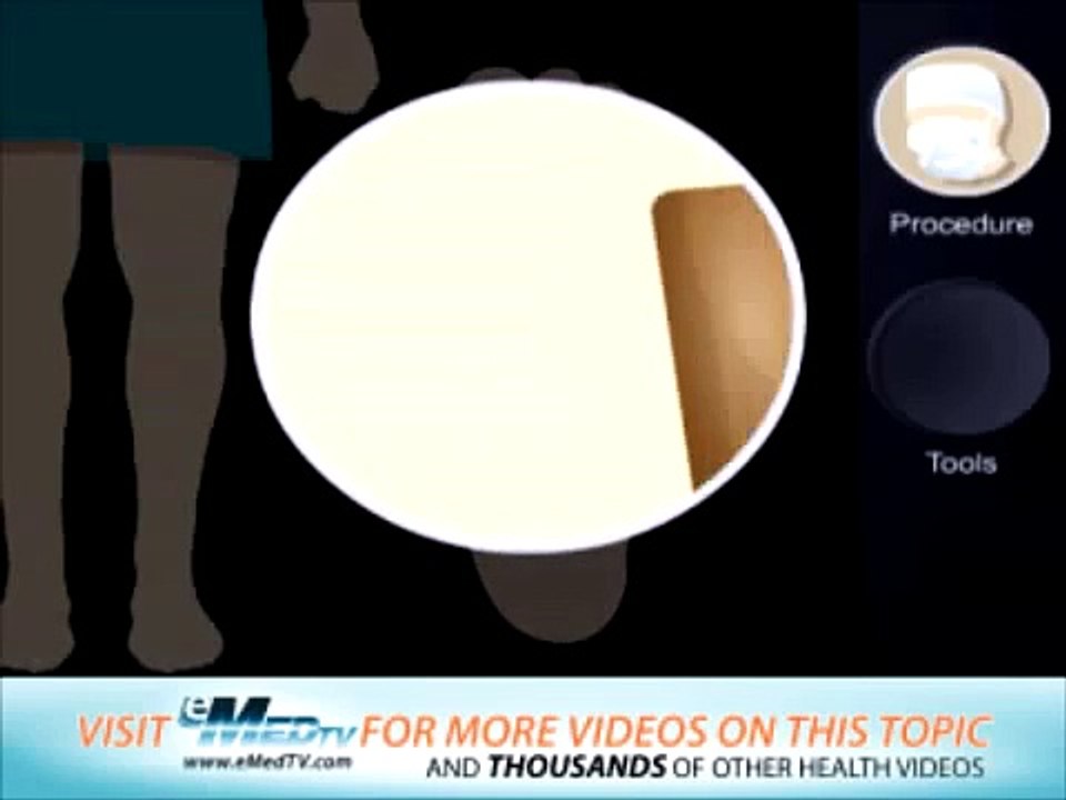 Bunionectomy Procedure