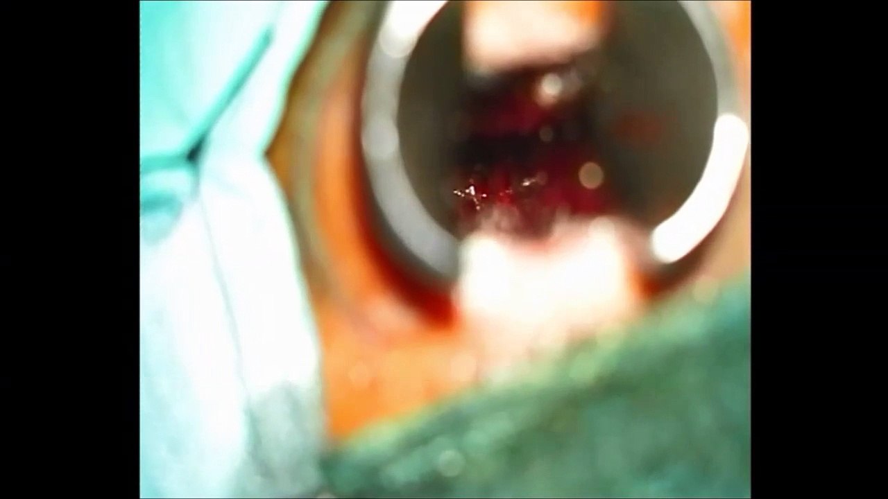 Endonasal Transphenoidal Resection of Pituitary Tumor