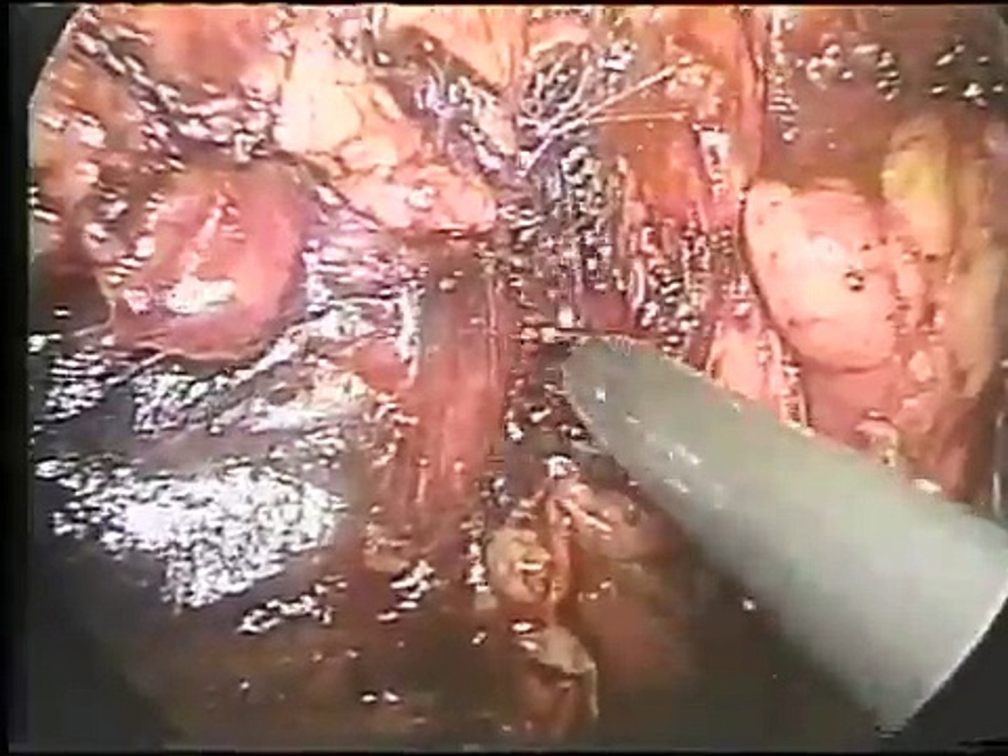 Popular Videos - Renal artery & Aneurysm