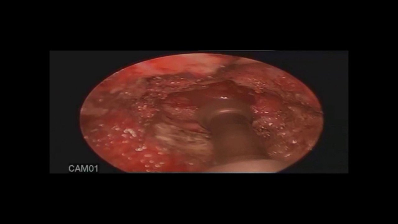 Endoscopic Lumbar Discectomy