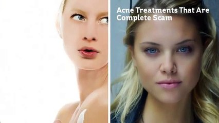 Acne Treatments That Are Complete Scam