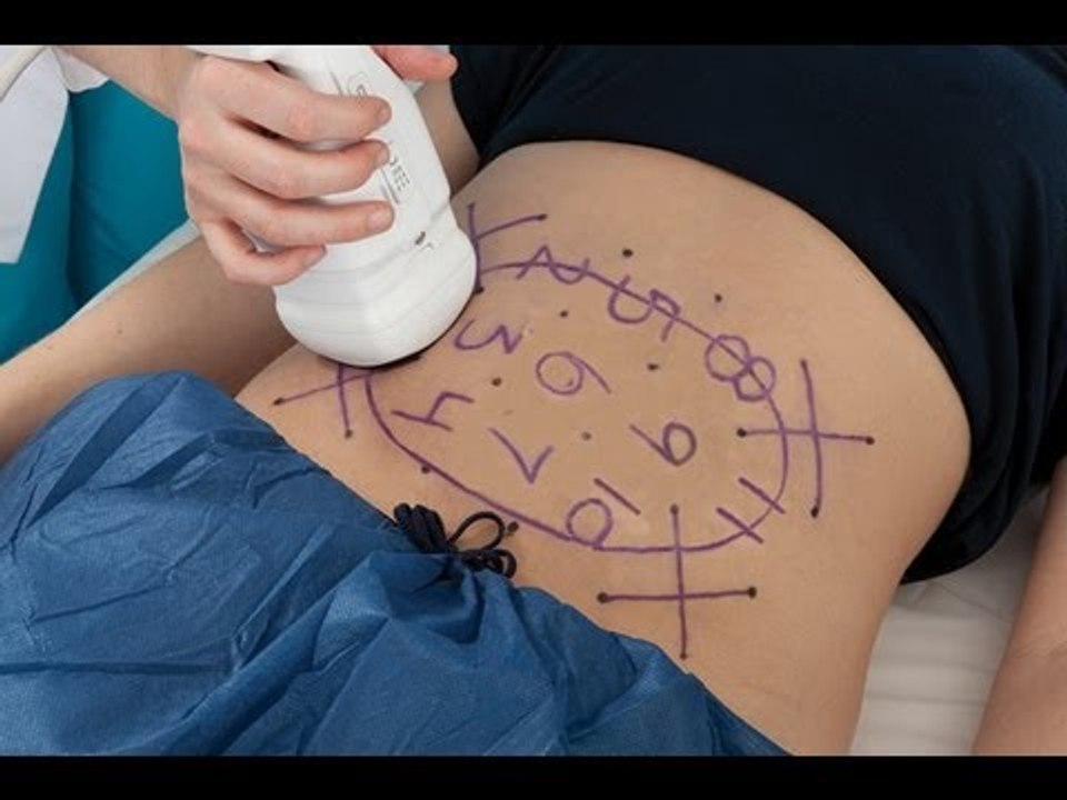 Tratamiento para Perder Centimetros de Cintura sin cirugía: Liposonix y Thermage