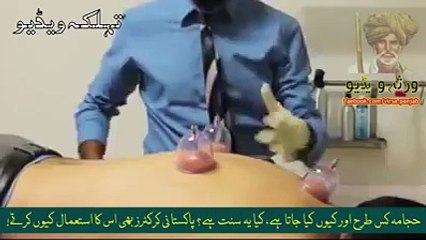 Hijama Cupping Thepary- The Best Treatment and A Forgotten Sunnah