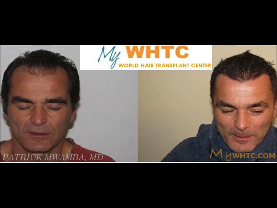hair transplant forum hair transplant results in the donor area by Dr. Patrick Mwamba