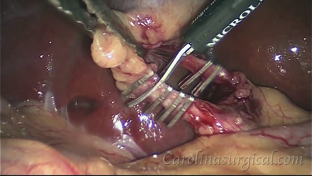 Laparoscopic Cholecystectomy (Gallbladder) Surgery