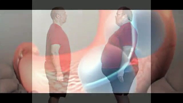 intragastric stomach weight loss balloon