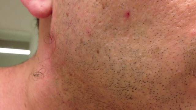 The Longest Grossest Ingrown Hair In History