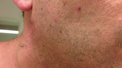 The Longest Grossest Ingrown Hair In History