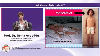 Malnutrisyon  | Prof Dr Sema Aydoğdu