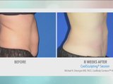 Freeze your fat at CoolBody Contours