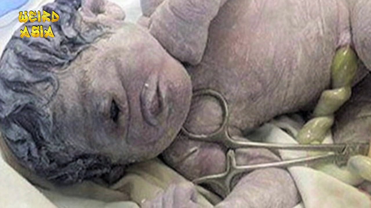 Baby Born With ONE Eye And NO Nose! | Shocking